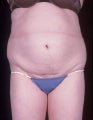 Liposuction