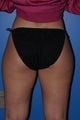 Liposuction