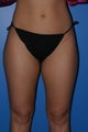 Liposuction