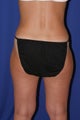 Liposuction