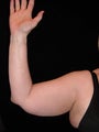 Tumescent Liposuction