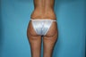 Liposuction of flanks and thighs
