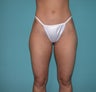 Liposuction of flanks and outer thighs