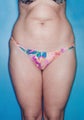 Power Assisted Liposuction (Hips, Thighs, Stomach & Back)