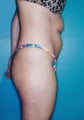 Power Assisted Liposuction (Hips, Thighs, Stomach & Back)