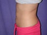 Tumescent Liposuction
