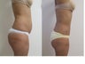 liposuction