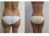 liposuction