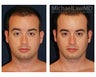 Chin Liposuction