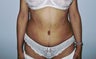 Abdominoplasty