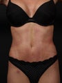 Abdominoplasty