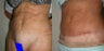 Tummy Tuck Revision