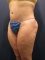 Abdominoplasty