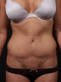Abdominoplasty