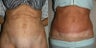 Tummy Tuck Revision