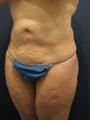 Abdominoplasty