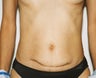Abdominoplasty Revision