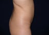 Tummy Tuck Revision