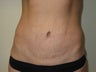 Tummy Tuck