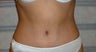 Tummy Tuck 