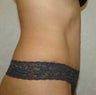 Tummy Tuck 