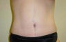 Tummy Tuck 