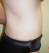 Tummy Tuck Before & After