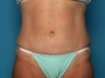 Tummy Tuck