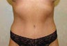 Tummy Tuck