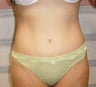 Tummy Tuck