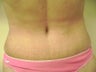 Tummy Tuck