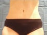 Tummy Tuck
