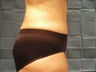Tummy Tuck