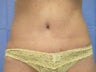 Tummy Tuck