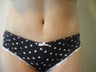 Tummy Tuck