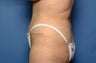 Tummy Tuck