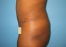 Tummy Tuck
