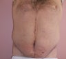 Tummy Tuck before and after