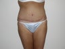 Abdominoplasty