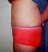Tummy Tuck