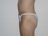 Tummy Tuck
