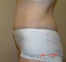 Tummy Tuck