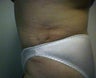 tummy tuck