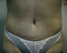 tummy tuck