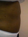 tummy tuck