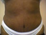 tummy tuck