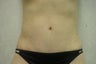 Tummy tuck
