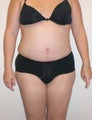 Tummy Tuck