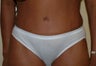 Tummy Tuck