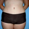 Tummy Tuck